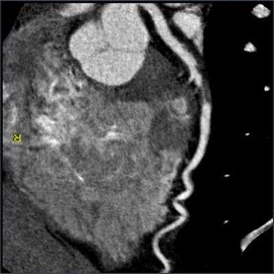 CCTA scan indicates severe stenosis in the left anterior descending artery of a 52-year-old patient with stable chest pain. Image courtesy of Dr. Christopher Maroules.
