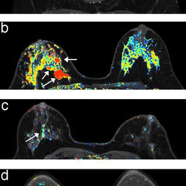 High-risk women benefit from twice-yearly breast MRI | AuntMinnie