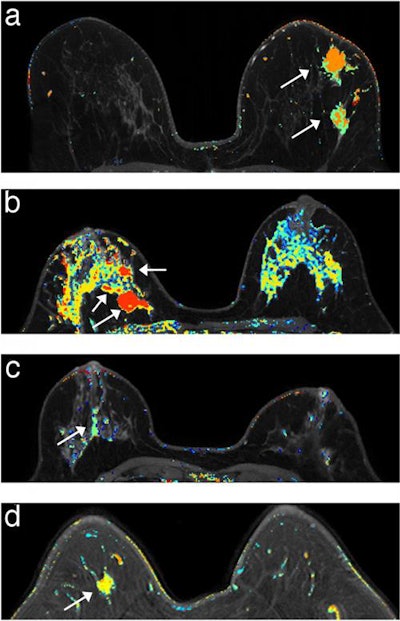 DCE-MRI every six months performed well for the early detection of invasive breast cancer in genomically stratified high-risk women. Image courtesy of Fred Pineda, PhD, University of Chicago Medicine.