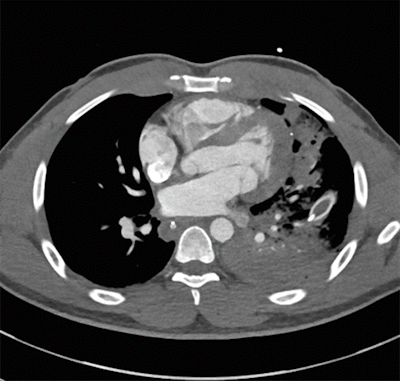 CT scan reveals a bullet fragment in the left ventricular wall (white speck in top right corner).