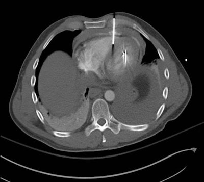 Chest CT scan of a nail gun injury that caused fluid to leak out of the pericardial sac. All images courtesy of Dr. Savvas Nicolaou.