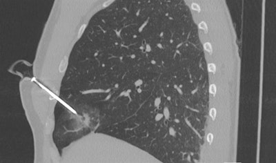 CT scan of a penetrating screw in the right side of the chest.