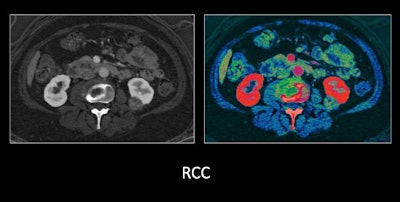 Abdominal dual-energy CT scan of a patient with renal cell carcinoma (RCC). Image courtesy of Dr. Bhavik Patel.