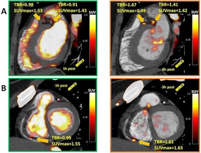 Images show significant NaF uptake in proximal left anterior descending, proximal circumflex (A), and distal right coronary artery (B) plaques, which had a target-to-background ratio (TBR) of less than 1.0 on one-hour PET and showed uptake exceeding the 1.25 TBR threshold at three hours. Image courtesy of JNM.