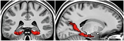 In the scene-object test, fMR images show memory activation from the posterior medial temporal lobe to the occipital cortex, incorporating both the posterior parahippocampal gyrus and retrosplenial cortex. Images courtesy of Neuron.