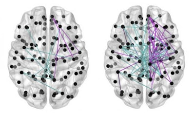 Brain maps based on data from MRI scans show that babies who received more breast milk (left) had fewer gaps in neural connectivity (colored lines) than babies who received less (right). Image courtesy of the Jennifer Brown Research Laboratory at the University of Edinburgh.