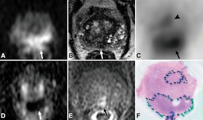 Images are from a 72-year-old man with prostate-specific antigen level of 5.9 ng/mL. Axial diffusion-weighted MR image (A) of midprostate and corresponding apparent diffusion coefficient map (D) demonstrate a single focus of restricted diffusion (arrow) in the midline posterior peripheral zone. The focus (arrow) has ill-defined low signal intensity on the T2-weighted MR image (B) and suspicious enhancement (E) on the dynamic T1-weighted postcontrast image. Corresponding PET scan (C) shows two separate areas of focal radiotracer uptake, including one focus in midline posterior peripheral zone with maximum standardized uptake value (SUVmax) of 11.7 (arrow) and an additional focus in the central aspect of the left anterior peripheral zone with an SUVmax of 6.2 (arrowhead). Histopathologic slide of midprostate (F) confirms the presence of two distinct tumors. Images courtesy of Radiology.