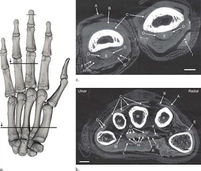 Volume-rendered reconstruction of the phase-contrast CT scan of a mummified hand (a). Axial view of the hand (b). Axial section of the third and fourth fingers (c). Image courtesy of RSNA.