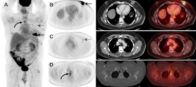 Images are from a 53-year-old man with stage IIB breast cancer that was upstaged to stage IV by FDG-PET/CT. Courtesy of the Journal of Nuclear Medicine.