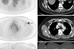 2018 09 25 20 01 0817 Fdg Pet Ct Male Breast Cancer 20180925204818