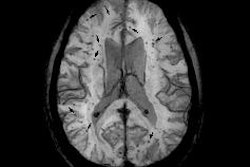 2018 09 26 20 59 9980 Brain Mri Microbleeds