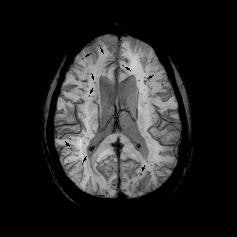 Brain MRI scan shows multiple cerebral microbleeds. Image courtesy of University of California, Irvine.