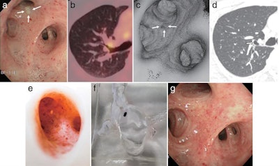 Selection of images from (a) bronchoscopy, (b) PET/CT, (c) virtual reality endoscopy, (d) CT, (e, f) 3D-printed models, and (g) bronchoscopy two months after treatment. Image courtesy of Yoon et al.