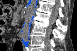 2018 10 01 20 57 7803 Ctc Aortic Calcification 20181001200944