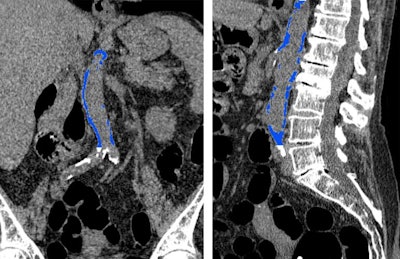 CT colonography scan showing abdominal aortic calcification (blue). Image courtesy of RSNA.