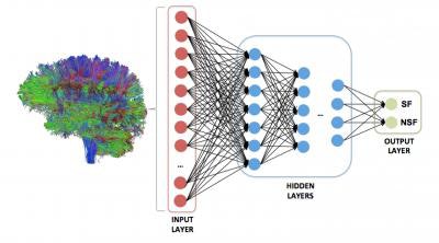 A deep neural network was trained to analyze the strength of all possible brain regions on a whole-brain structural connectome to predict one of two outcomes: seizure freedom or seizure refractoriness. Image courtesy of Dr. Ezequiel Gleichgerrcht and Dr. Leonardo Bonilha of MUSC.