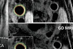 2018 10 08 22 29 5457 Carotid Mri Ultrasound Wasserman 20181008224453