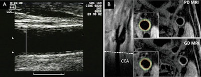 Ultrasound (A) and MR images (B) show common carotid artery (CAA) wall thickness assessment in a 62-year-old man. Intima-media thickness of the far wall was measured below the carotid bulb, starting where the outer wall of the artery begins to diverge (A). Corresponding MR images (B) show location of CCA section (dashed line) on long-axis view of left carotid bifurcation, with noncontrast proton density (PD)-weighted and intravenous gadolinium-enhanced (GD) MR images obtained at this location. Insets show inner and outer boundaries of segmented vessel walls, with white radial lines delineating 12 sectors over which wall thickness was computed. Images courtesy of Radiology.