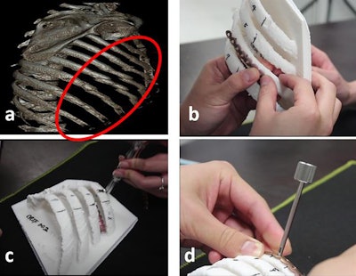 3D reconstruction of chest CT scans (a). Model of 3D-printed rib used to measure the ideal length and shape for the titanium plate implant (b, c, d). Image courtesy of Chen et al.