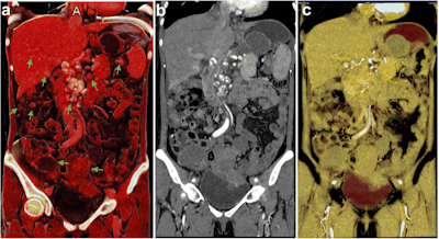 Cinematically rendered CT scan of the abdomen and pelvic cavity of a patient with ovarian cancer and metastases (a). Multiplanar reconstruction of the same CT scan shows an overall view of the lesions comparable to that of cinematic rendering but with less detail (b). The volume-rendered CT scan does not display the lesions clearly (c). Image courtesy of Jin et al. CC BY 4.0.