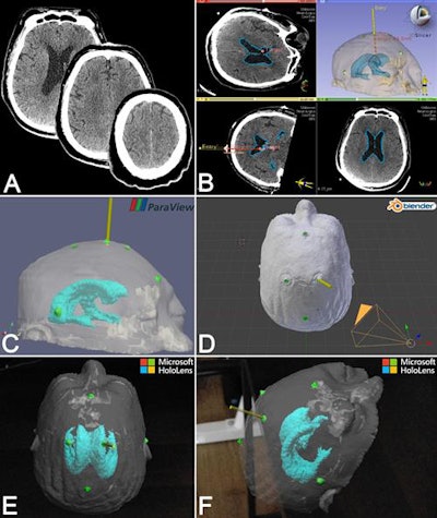 Visualization and presurgical planning on CT scans (A), 3D virtual models (B, C, D), and augmented reality holograms (E, F). Image courtesy of the American Association of Neurological Surgeons.