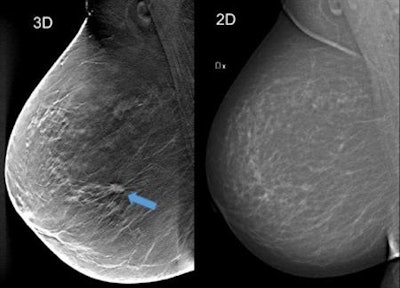 Using breast tomosynthesis (3D screening) in the image to the left (one of about 50 thin cross-sectional image slices of the breast), you can see an approximately 1 cm-large tumour that is not clearly visible on the mammography image on the right, even though the breast does not contain particularly dense tissue. Image courtesy of Skåne University Hospital in Malmö.