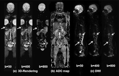 Whole-body DWI of a 46-year-old woman with metastatic breast cancer includes 3D visualization of metastatic lesions (a) using different b-values from DWI. There are progressive changes in the DWI signal intensity within the metastatic sites (white arrows) of the left pelvis, thoracic and lumbar spine, and liver. Also shown is a coronal ADC map (b) through the midsection of the patient. Different b-values from DWI sagittal images (c) of the spine show multiple metastatic regions. Images courtesy of Academic Radiology.