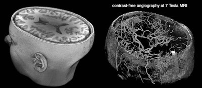 A 3D rendering of a 7-tesla brain MRI scan (left). Time-of-flight MR angiography (right) images blood flow without the need to administer contrast. One of the main applications of 7-tesla MRI is in the diagnosis of intracranial aneurysms. Image courtesy of Dr. Farshid Sepehrband and Arthur Toga, PhD.