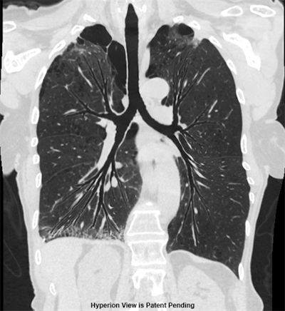 LungPrint Discovery's Hyperion View provides visualization of the lung in a single image. Image courtesy of Vida.