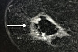2018 11 14 22 00 1067 Cryoablation2 Sm 20181114224653