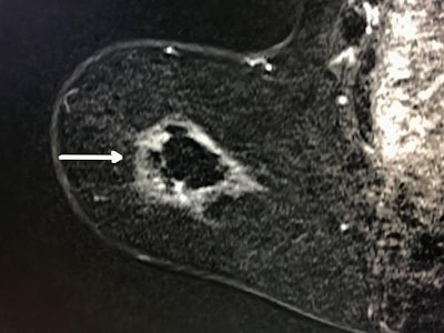 MRI after ablation shows white outline of ablation zone referred to as 'cryohalo' with normal dark breast tissue centrally and no evidence of residual cancer (arrow). Image courtesy of RSNA.