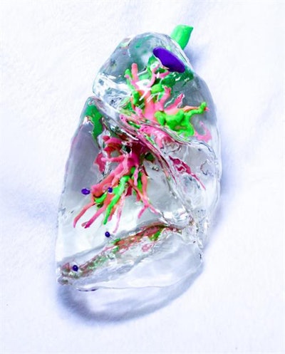Transparent, flexible 3D-printed lung model of a 99-year-old man with primary lung adenocarcinoma and minimally invasive adenocarcinoma (purple) in the right upper and lower lobes. Tracheobronchial structures are in green and pulmonary vessels in pink. Image courtesy of Dr. Soon Ho Yoon.