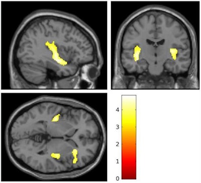 Images show brain regions where researchers saw reductions in brain volume in girls who self-injure. Courtesy of Ohio State University.