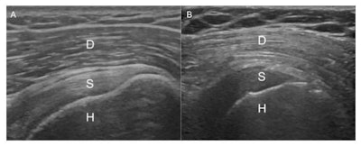 Shoulder images show reversal of the rotator cuff-to-deltoid gradient. Image A shows the normal gradient of the deltoid muscle to the supraspinatus tendon. Image B shows reversal of the normal gradient in a type 2 diabetic patient. D = deltoid, S = supraspinatus, and H = humerus. Image courtesy of RSNA.