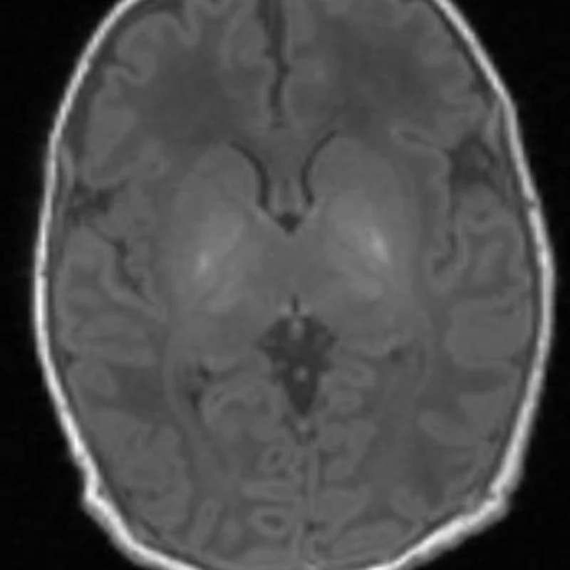 Mrs. Brain Example MR spectroscopy offers insight into neonates' brain damage | AuntMinnie