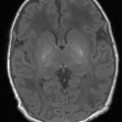 2018 11 16 22 13 2061 Mrs Brain Damage Neonates Lancet 20181116225605