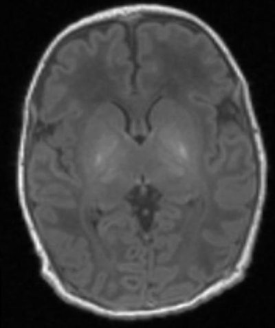 MR spectroscopy shows the brain of a baby with brain damage. There is abnormal brightness in the deep nuclei in the center of the brain. Image courtesy of Imperial College London.