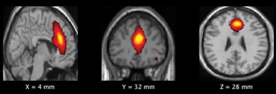MR images of the frontal default mode network show brain regions where there was a significant difference in gray-matter volume between the high- and low-impact groups. Images courtesy of Murugesan et al and RSNA.