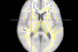 2018 11 20 22 32 1900 Rsna Dti Alzheimers Raji 20181120225025