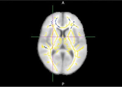 DTI-MRI shows areas of reduced fractional anisotropy, indicating damage in the brain's white-matter tracts. Image courtesy of Dr. Cyrus Raji and RSNA.