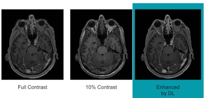 Images show differences in image quality based on the amount of gadolinium-based contrast administered. Courtesy of Gong et al and RSNA.