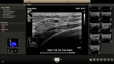 Philips' ultrasound for breast assessment. Image courtesy of Philips Healthcare.