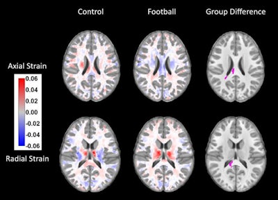 Brain MRI scans display statistically significant changes (violet) between the brains of kids before and after football season. Image courtesy of RSNA.