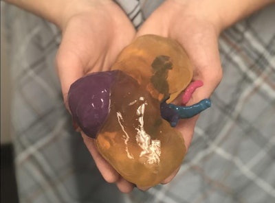 3D-printed kidney with color-coded structures, including tumor (purple), arteries (pink), veins (light blue), and the collecting duct system (dark blue). Image courtesy of Nicole Wake, PhD.