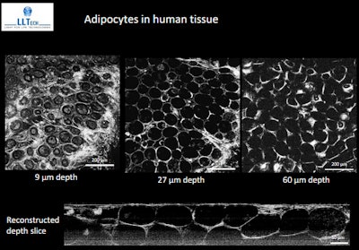 Adipocytes are cells that store energy as fat, mainly triglycerides, in organelles called lipid droplets. Image courtesy of LLTech Imaging.