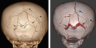 An 18-month-old girl with multiple skull fractures (arrows) visible on 3D head CT and 3D black bone MRI scans. Image courtesy of Dr. Stephen Kralik.
