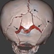 2018 11 30 22 39 3837 Black Bone Mri Skull 20181130224656
