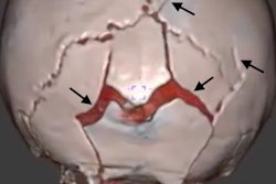 2018 11 30 22 39 3837 Black Bone Mri Skull 20181130224656