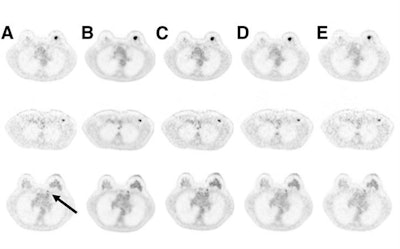 Axial PET images of a 57-year-old patient show invasive breast cancer (top), axillary lymph node metastasis (middle), and internal mammary lymph node (bottom, arrow) after 180 MBq of FDG based on body weight. The images show two-minute TOF (A), 100% of FDG dose (B), 36 MBq of FDG (20% dose) (C), 18 MBq of FDG (10% dose) (D), and 9 MBq of FDG (5% dose) (E). Based on 10% FDG dose, this patient would have an estimated radiation burden of 0.36 mSv. Image courtesy of JNM.