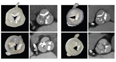 Four distinct 3D-printed heart valve models shown next to their corresponding CT scans, with calcified deposits in white. Image courtesy of the Wyss Institute at Harvard University.